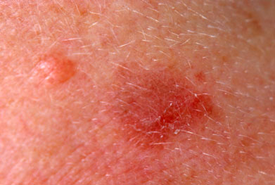 In the UK, actinic keratosis affects approximately one in four people aged 60 years and over | SCIENCE PHOTO LIBRARY
