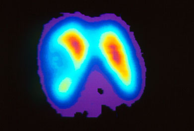 Caprelsa may be less beneficial in patients with medullary thyroid carcinoma when rearranged during transfection (RET) mutation is negative or unknown | SCIENCE PHOTO LIBRARY