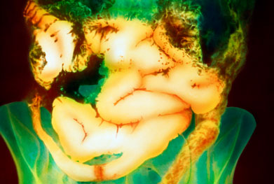 Coloured X-ray of the intestine in Crohn’s disease | SCIENCE PHOTO LIBRARY