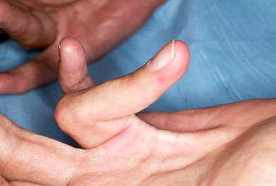 Xiapex offers treatment for Dupuytren's contracture that works as an alternative to surgery