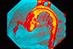 kawasaki diseae shows as dilated coronary arteries in an angiogram (Photograph: SPL)