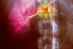 Renal artery stenosis: percutaneous revascularisation improves patency but shows limited clinical benefit