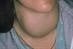 Thyrotoxic goitre: thyrotoxicosis may cause excessive sweating