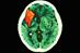 Stroke: cognitive problems can have a significant impact on recovery