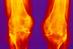 Rheumatoid arthritis: cost of pharmacological management is rising