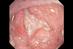 A GI problem such as Crohn's disease may cause rapid weight loss in patients (Photograph: SPL)