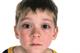 A Unique Child: Health - A guide to ... conjunctivitis