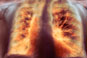 First targeted treatment for idiopathic pulmonary fibrosis approved by NICE