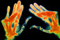 Abatacept now approved for rheumatoid arthritis after failure of conventional DMARDs
