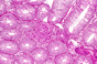 NICE approval for adalimumab in Crohn's disease