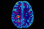 More good news for patients awaiting MS tablet 