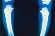 The Basics - Vitamin D deficiency