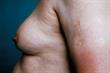The Basics - Gynaecomastia