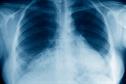 Emergency Medicine - Acute respiratory failure