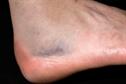 CKS Clinical solutions - Analgesia