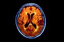 Journals Club - Antipsychotic prescribing for patients with dementia