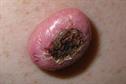 Identify this upper arm lesion