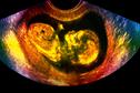 Clinical Review: Reduced fetal movements