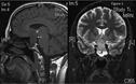 Clinical Review: Hypopituitarism