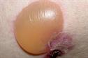 Clinical review: Bullous pemphigoid