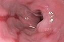 Emergency Medicine: Gastrointestinal bleeding