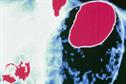 CKS Clinical solutions - Dyspepsia