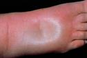 Pitting oedema