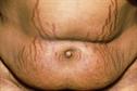 Clinical Review - Cushing's syndrome