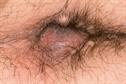 CKS Clinical Solutions - Pruritus ani