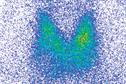 Journals Watch - Thyroid cancer, pre-eclampsia and mammography