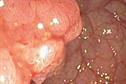 Journals Club - Colorectal cancer screening
