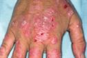 Illustrated - Lupus erythematosus
