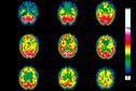 Clinical Review: Huntington's disease