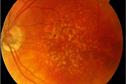 Clinical Review - Macular degeneration