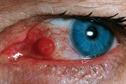 Pictorial case study: Swelling on the eye
