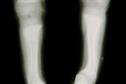Treating vitamin D deficiency to cost £100m a year by 2013