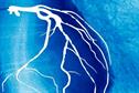 Journals Club - NSAIDs and cardiovascular disease risk