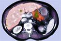 Clinical review: Management of pancreatic cancer