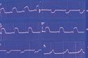 Emergency medicine - Acute coronary syndromes