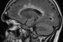 Clinical Review - Multiple sclerosis