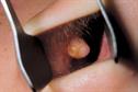 GP management of sinusitis