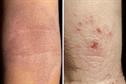 Clinical Review - Atopic eczema