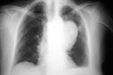 Clinical review: Lung cancer