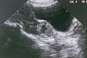 Clincal Review: Ectopic pregnancy