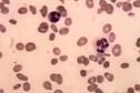 Management of pernicious anaemia
