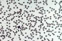 Haematology - Sickle cell anaemia