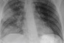 Clinical Review - Community-acquired pneumonia