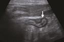 Clinical Review: Acute appendicitis