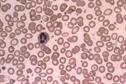 Clinical review: Microcytic anaemia