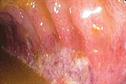 Clinical Review - Mesenteric ischaemia